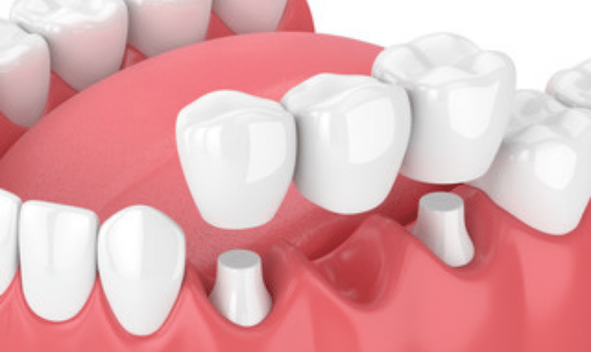 Dental bridges
