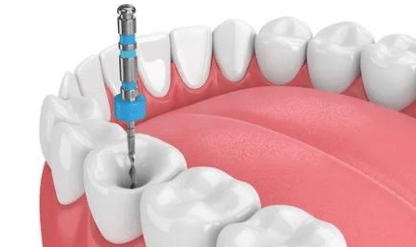 Root Canal Aftercare: Your Complete Guide To A Speedy Recovery