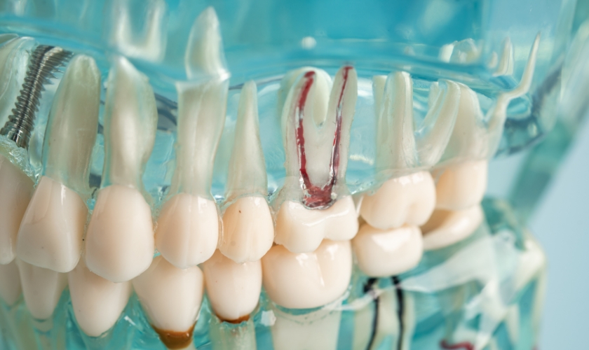 understanding endodontics a guide to root canal therapy