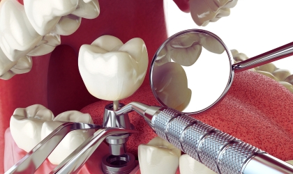 the complete guide to molar tooth implant surgery
