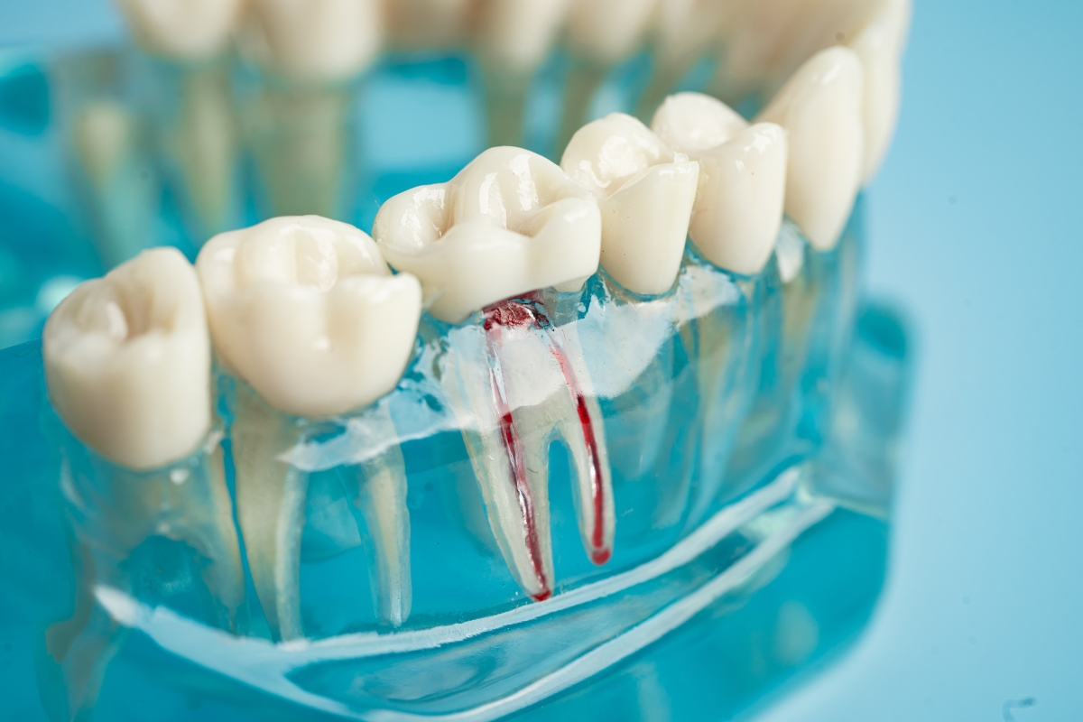 Root-canal-treatment-in-Salt-Lake-City